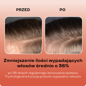 Stimulierendes Kopfhautpeeling gegen Haarausfall mit 3% Shikimisäure, 3% Glykolsäure, Adenosin und fermentiertem Ginseng-Extrakt